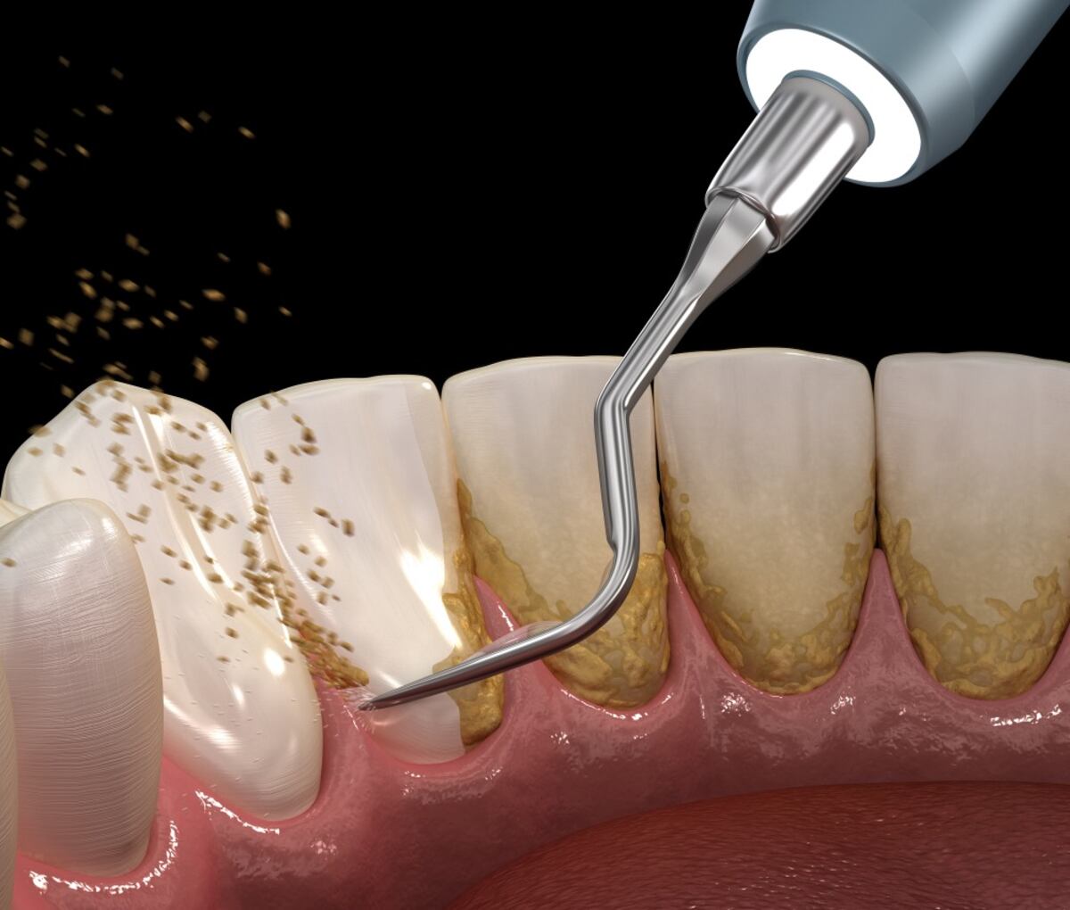 El verdadero “truco” para eliminar el sarro y tener dientes blancos: lo que recomienda el odontólogo