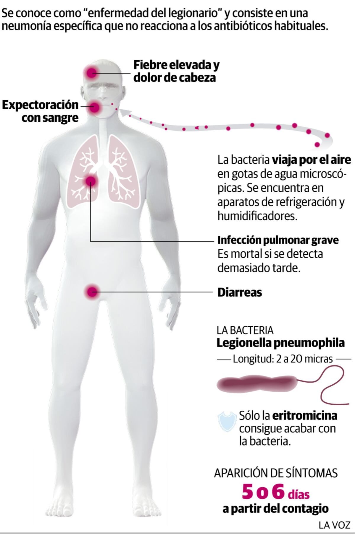 Síntomas de la legionela