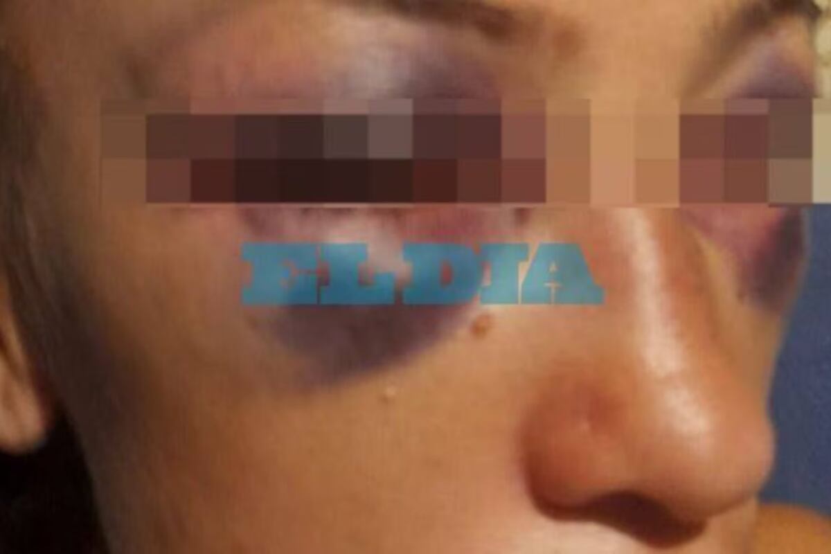 Brutal ataque en La Plata: una patota golpeó a una joven de 33 años cuando salía del boliche (Foto: gentileza)