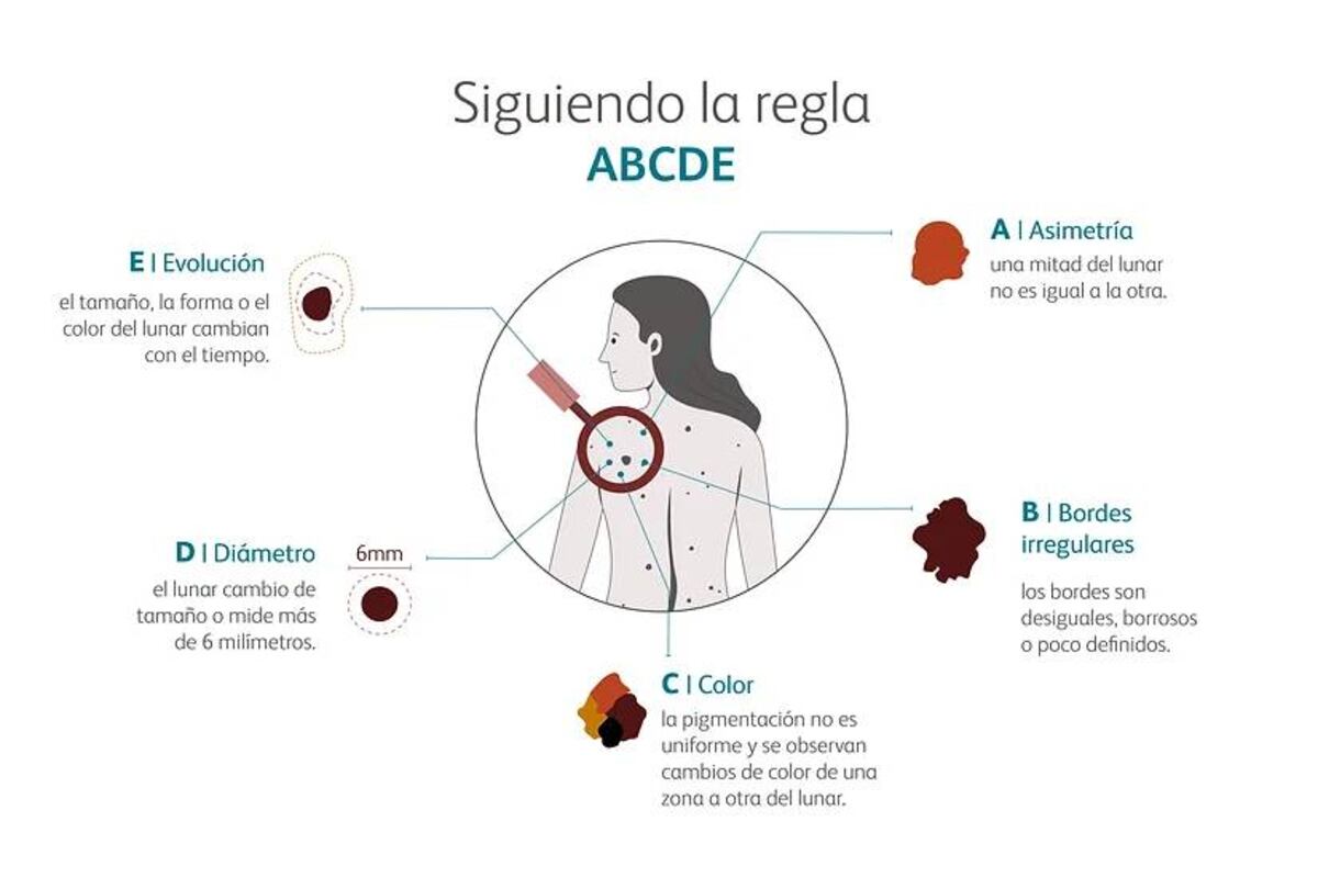 La regla del ABCDE sirve para que cada persona pueda distinguir en su propia piel un lunar normal de un melanoma. (Gentileza)