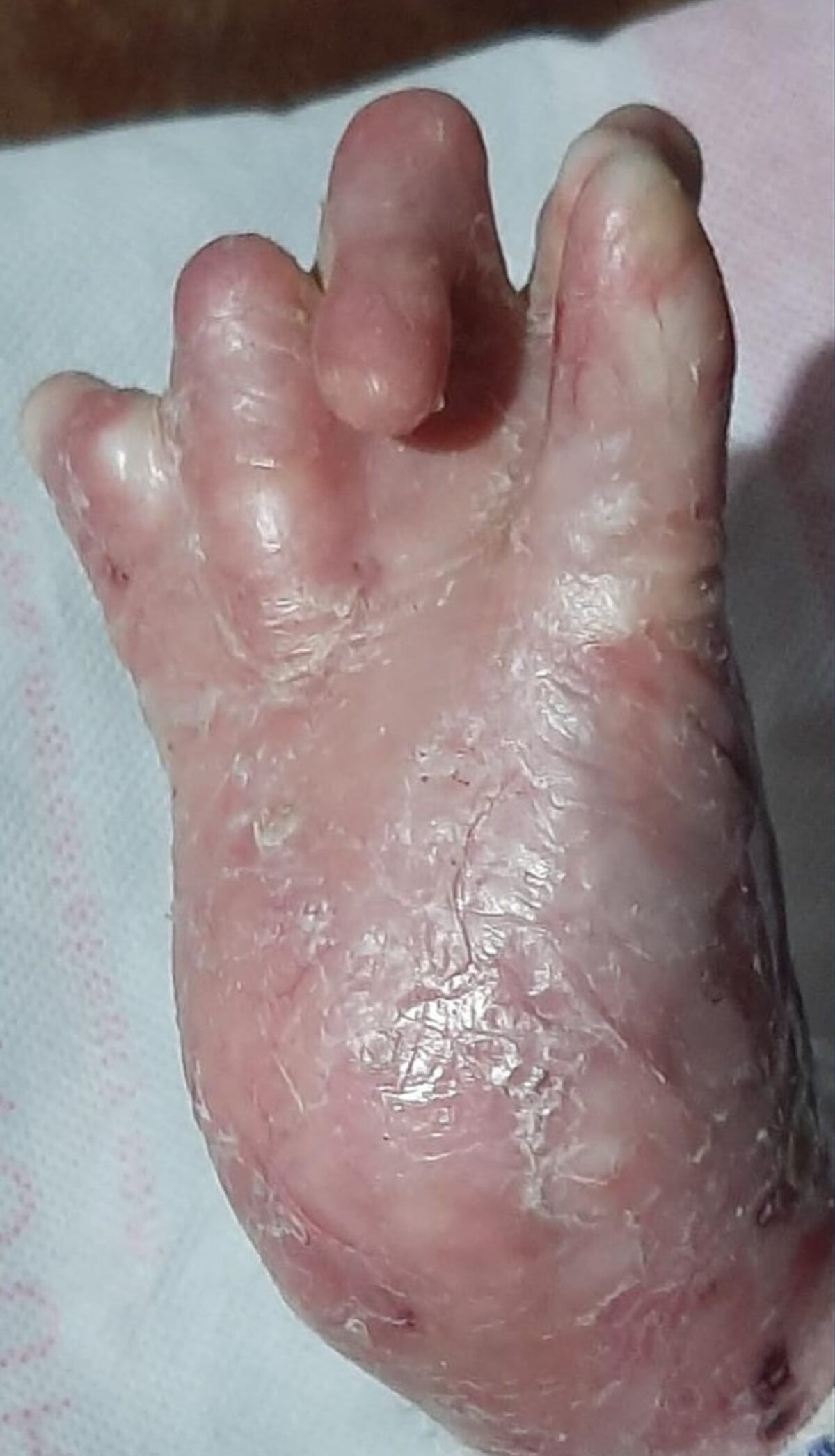 Anahí Vázquez padece de epidermólisis ampollar y necesita operarse para no perder sus manos. (TN)