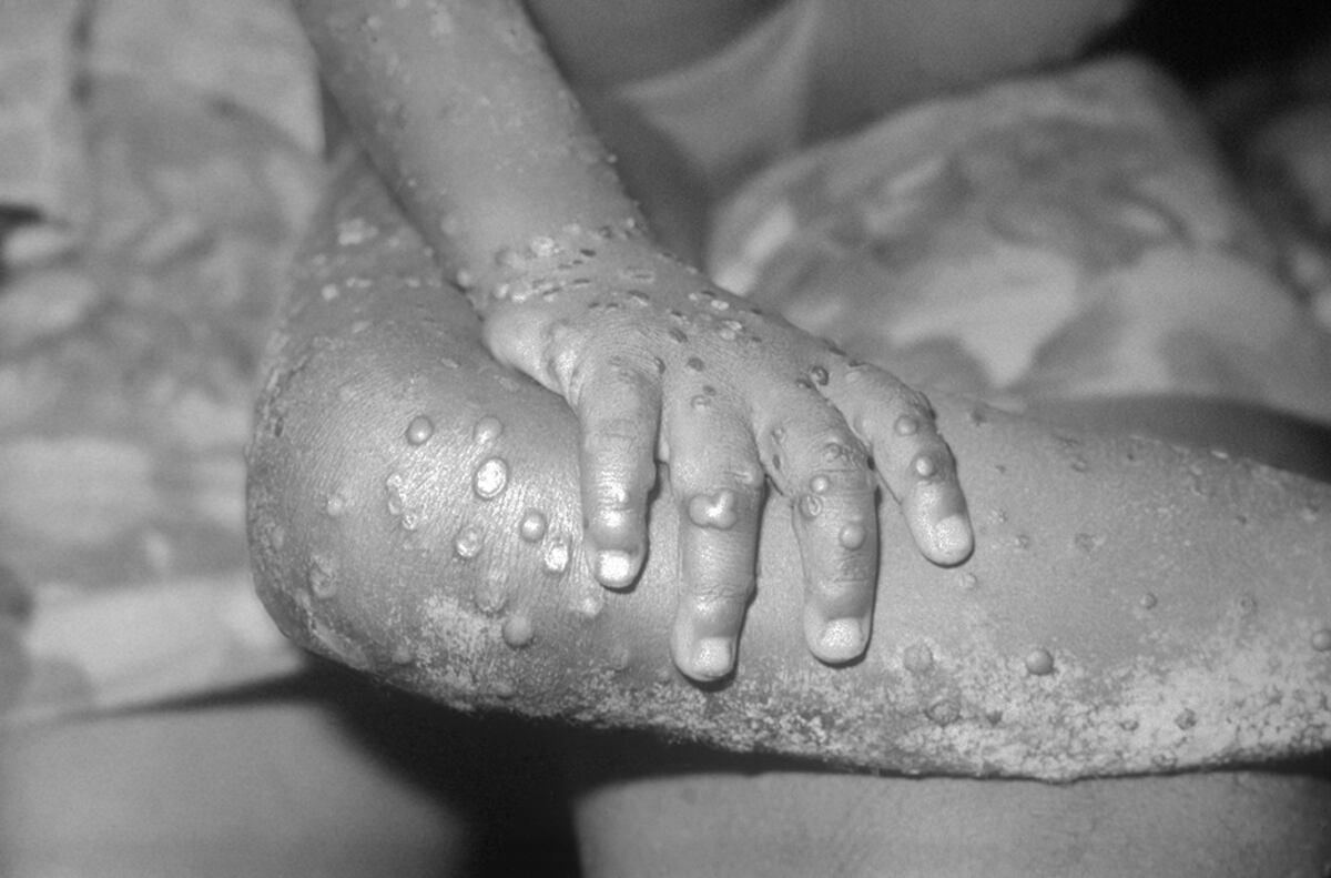 Virus de la viruela del mono - Lesiones
Infección humana con virus similar a la viruela del simio en una hembra de 4 años, Bondua, condado de Grand Gedeh, Liberia. La infección fue causada por un virus de la viruela del tipo vacunaa, variola, viruela del simio.
Fuente: CDC Centro para el Control y Prevención de Enfermedades de Estados Unidos