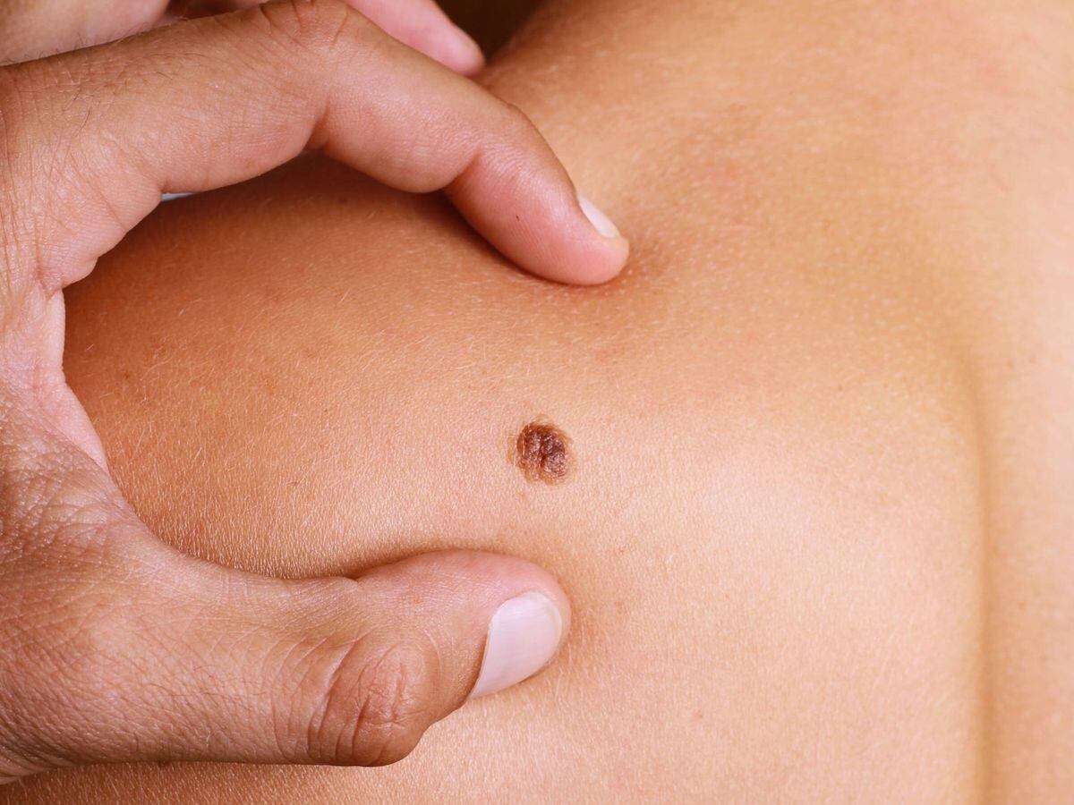 La revolución del mapeo digital de lunares para la detección temprana del cáncer