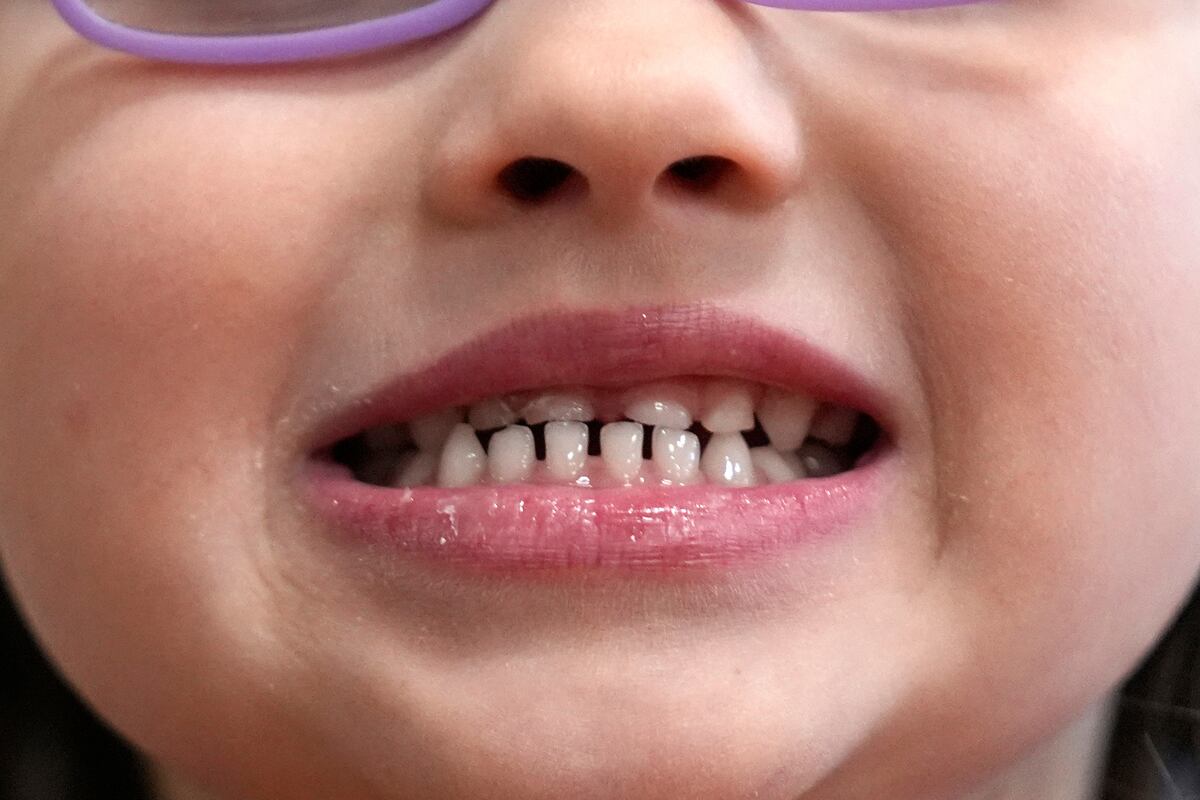 Una niña muestra sus dientes después de un examen dental en Concord, Nueva Hampshire, el miércoles 21 de febrero de 2024. (AP Foto/Robert F. Bukaty, archivo)
