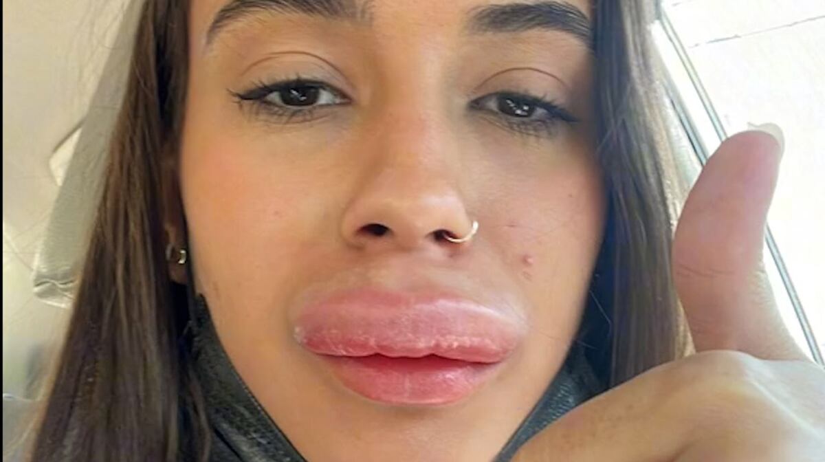 Una joven intervino sus labios, y una reacción la dejó deformada. (@isispolivx)