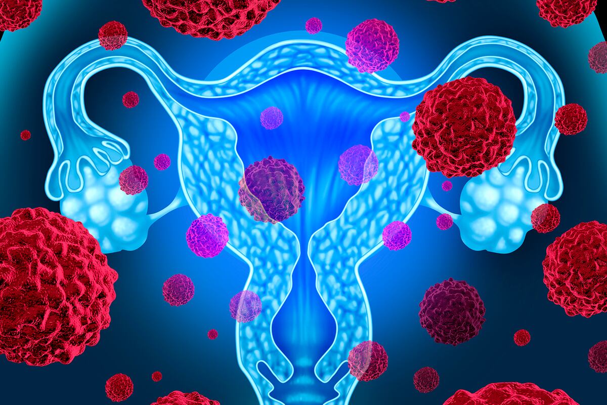 Células cancerosas en el útero. Foto: Depositphotos.