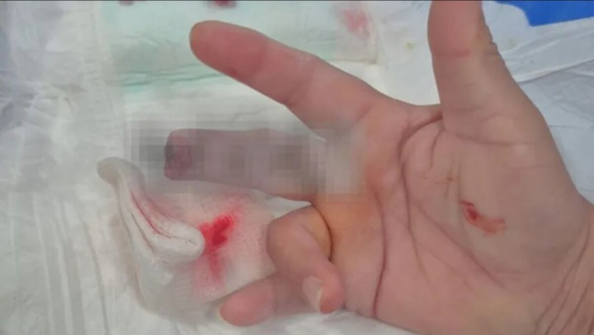 Chaco: un hombre mordió y le arrancó un dedo a la enfermera que lo estaba atendiendo (Gentileza)