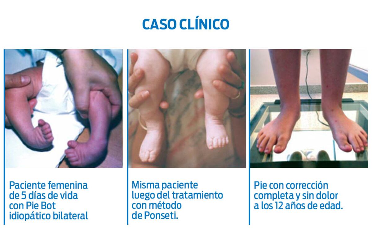Caso clínico de Pie Bot / Sanatorio Allende