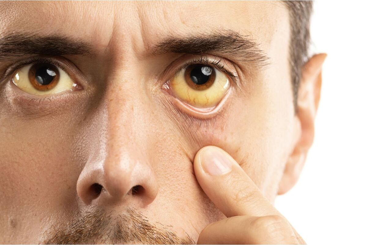 Ictericia, uno de los síntomas de la Hepatitis A.