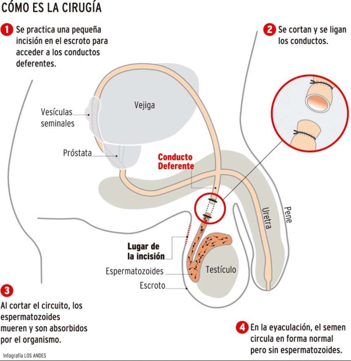 Vasectomías: crece el interés y se duplicó el número de operaciones