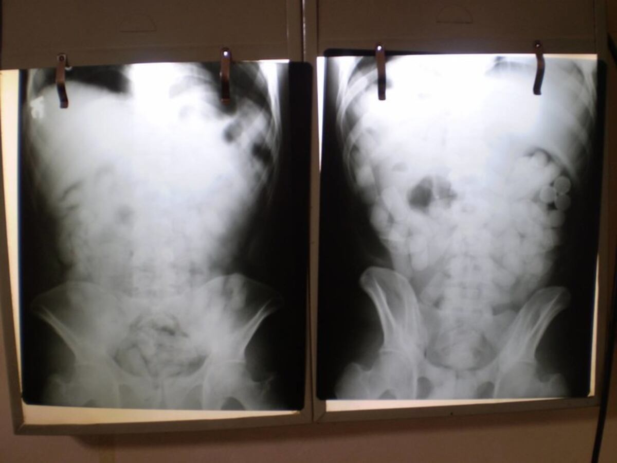 Iba a viajar 36 horas con 90 cápsulas de cocaína en sus intestinos: salió de Perú y cayó en Ezeiza.