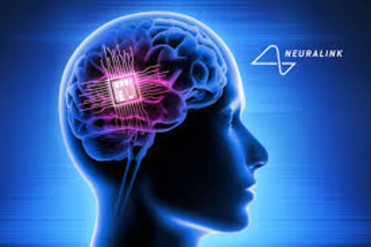 El chip N1 de Neuralink: cómo funciona y qué cambia en la vida de los pacientes