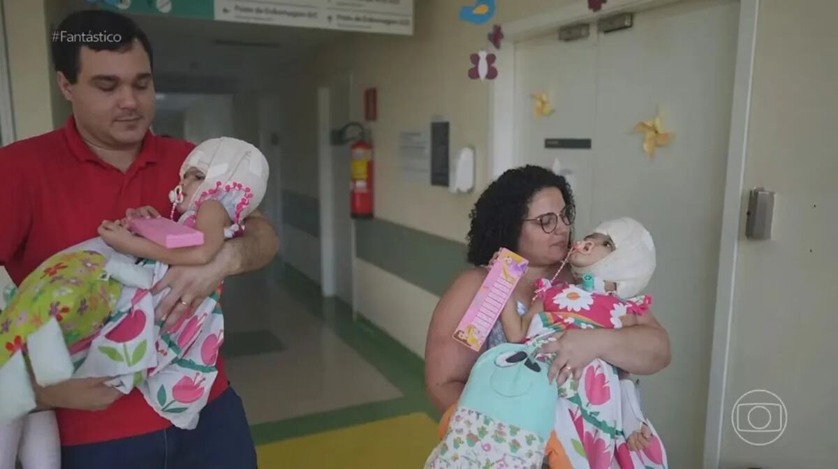 Lograron separar a dos siamesas que estaban unidas por el cráneo. (Gentileza g1)