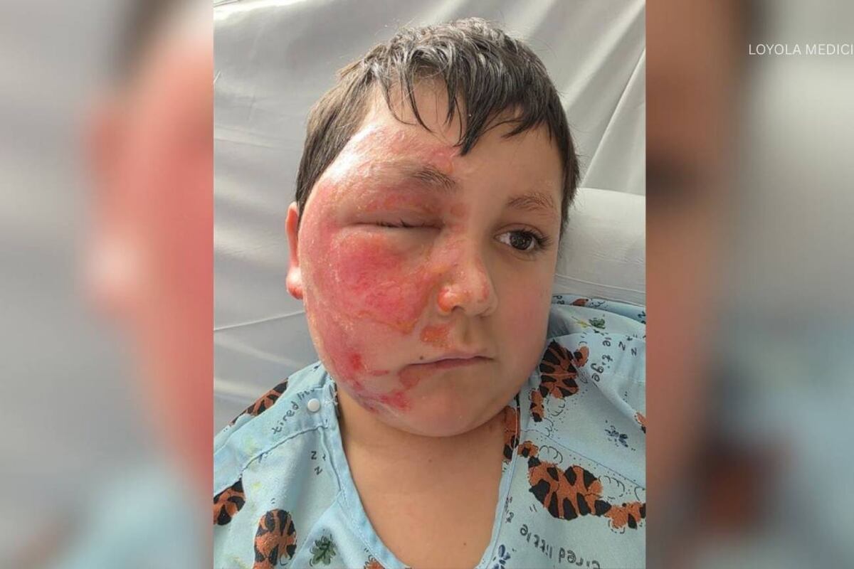 Médicos explicaron que el gel del juguete es tóxico, se pega al tejido y es difícil de sacar una vez que se calienta, lo que aumenta el riesgo de cicatrices profundas y permanentes. (ABC7CHICAGO)
