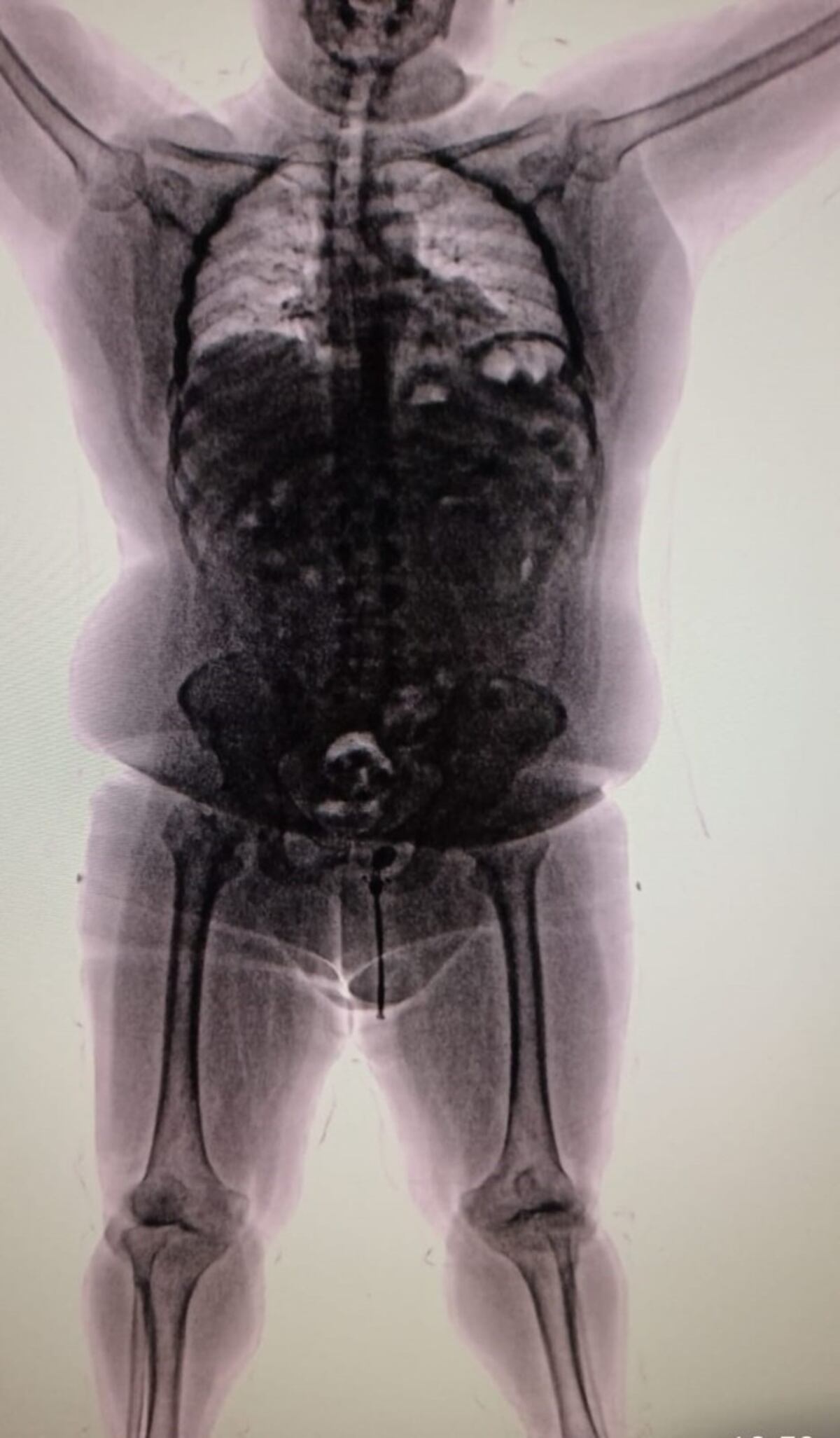 Iba a viajar 36 horas con 90 cápsulas de cocaína en sus intestinos: salió de Perú y cayó en Ezeiza.