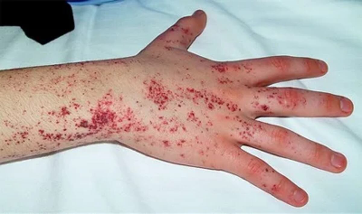 Angioqueratomas, uno de los síntomas de la enfermedad de Fabry. (Freepik)