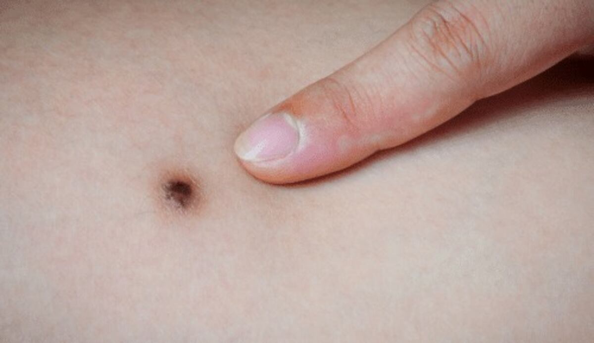 La revolución del mapeo digital de lunares para la detección temprana del cáncer