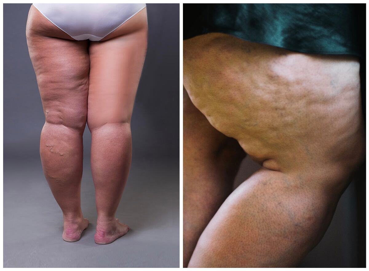 Lipedema (Le Clan)