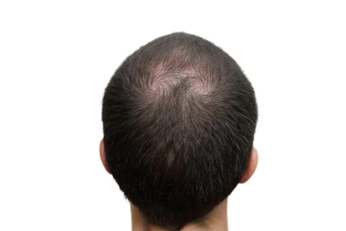 El brazo robótico de Artas funciona con algoritmos inteligentes y puede detectar los mejores cabellos para extraer y luego implantar. (Foto: Hair Recovery)