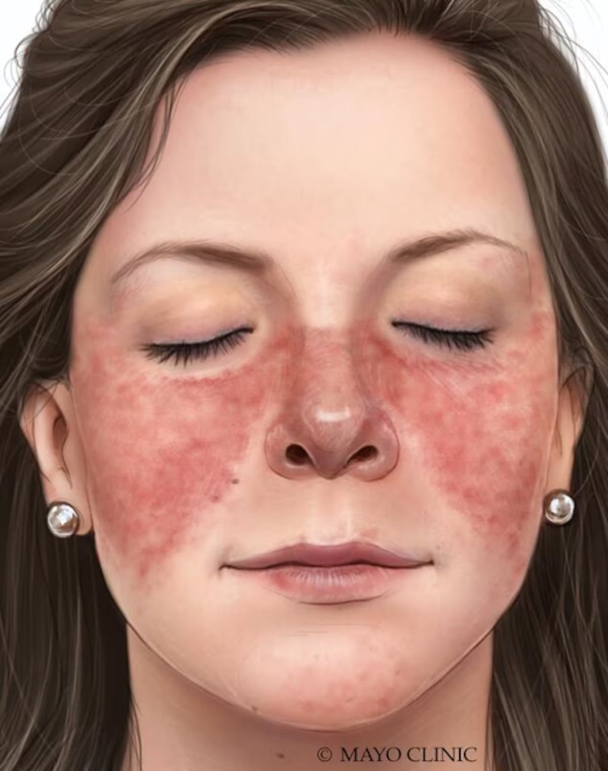El diagnóstico no te define: la importancia de recibir información y contención sobre lupus