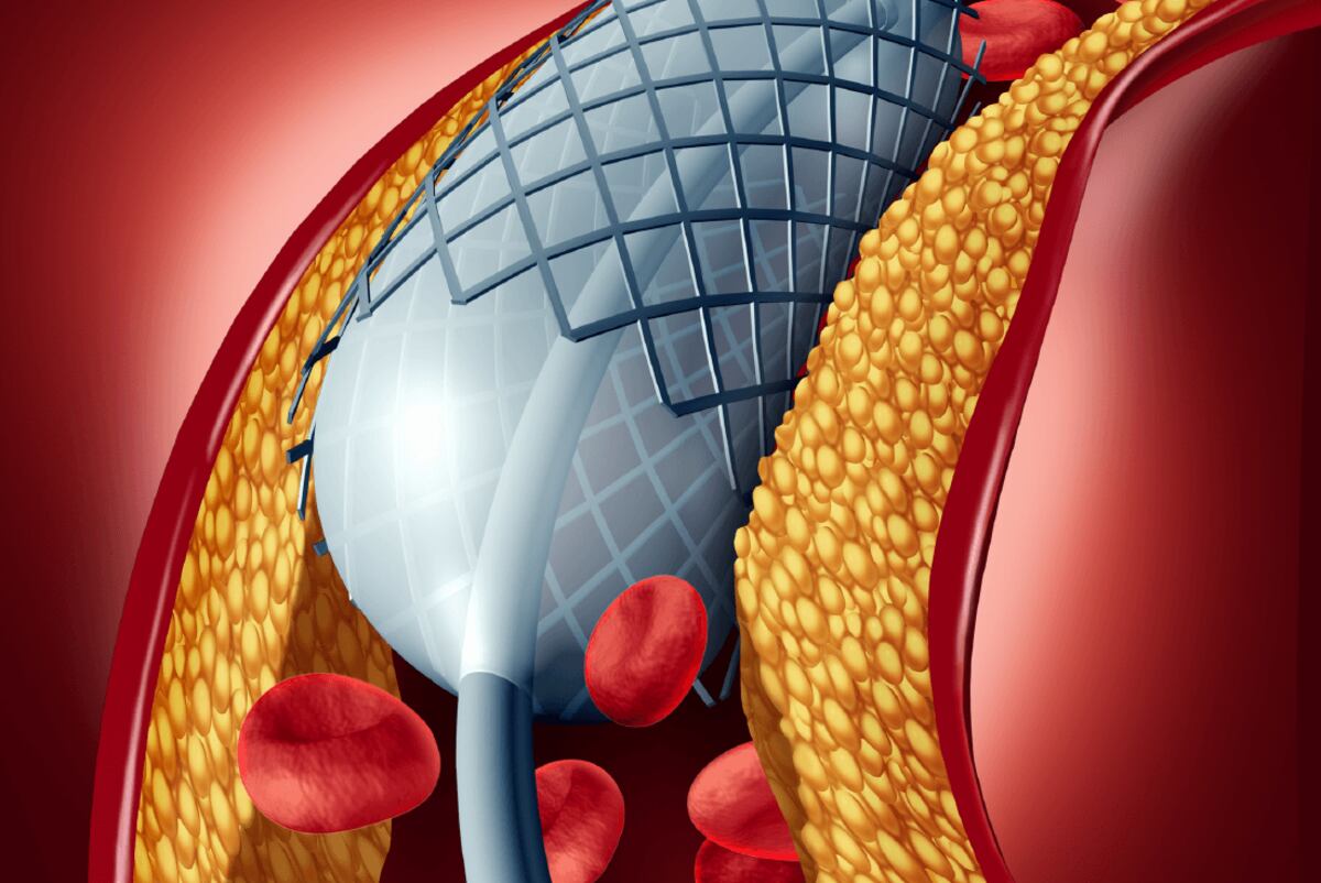 Una de las opciones más convencionales para tratar las obstrucciones de arterias es angioplastia coronaria. / Sanatorio Allende