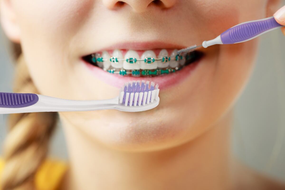 Brackets en los chicos: cómo acompañarlos en el tratamiento