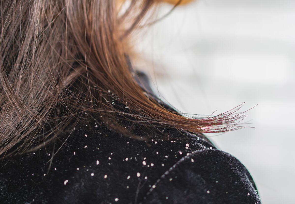 Cómo eliminar la caspa del pelo.