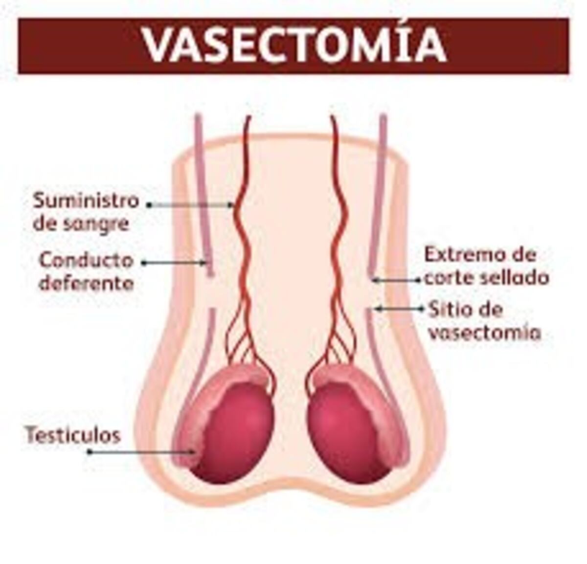 Vasectomía web