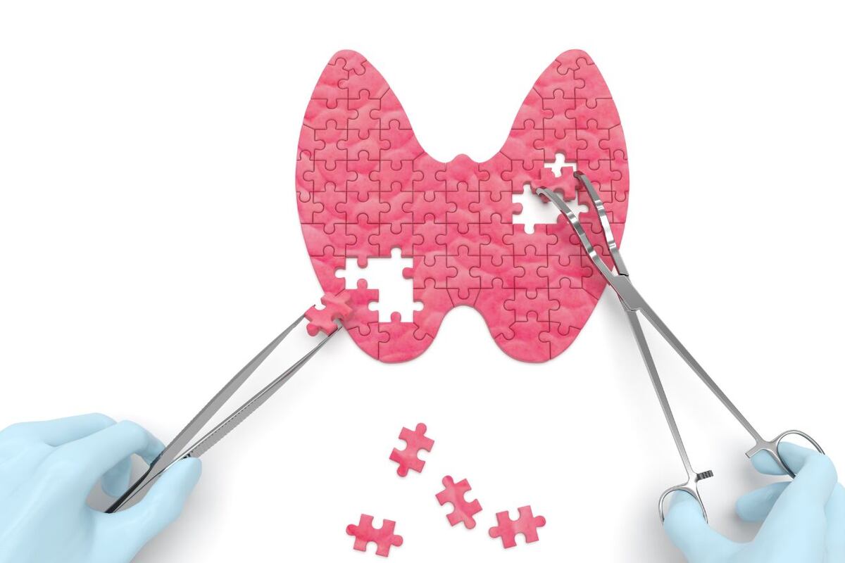 La tiroidectomía TOETVA se distingue por ser un abordaje transoral, lo que significa que es una técnica quirúrgica en la que se accede a la zona de interés a través de la boca.