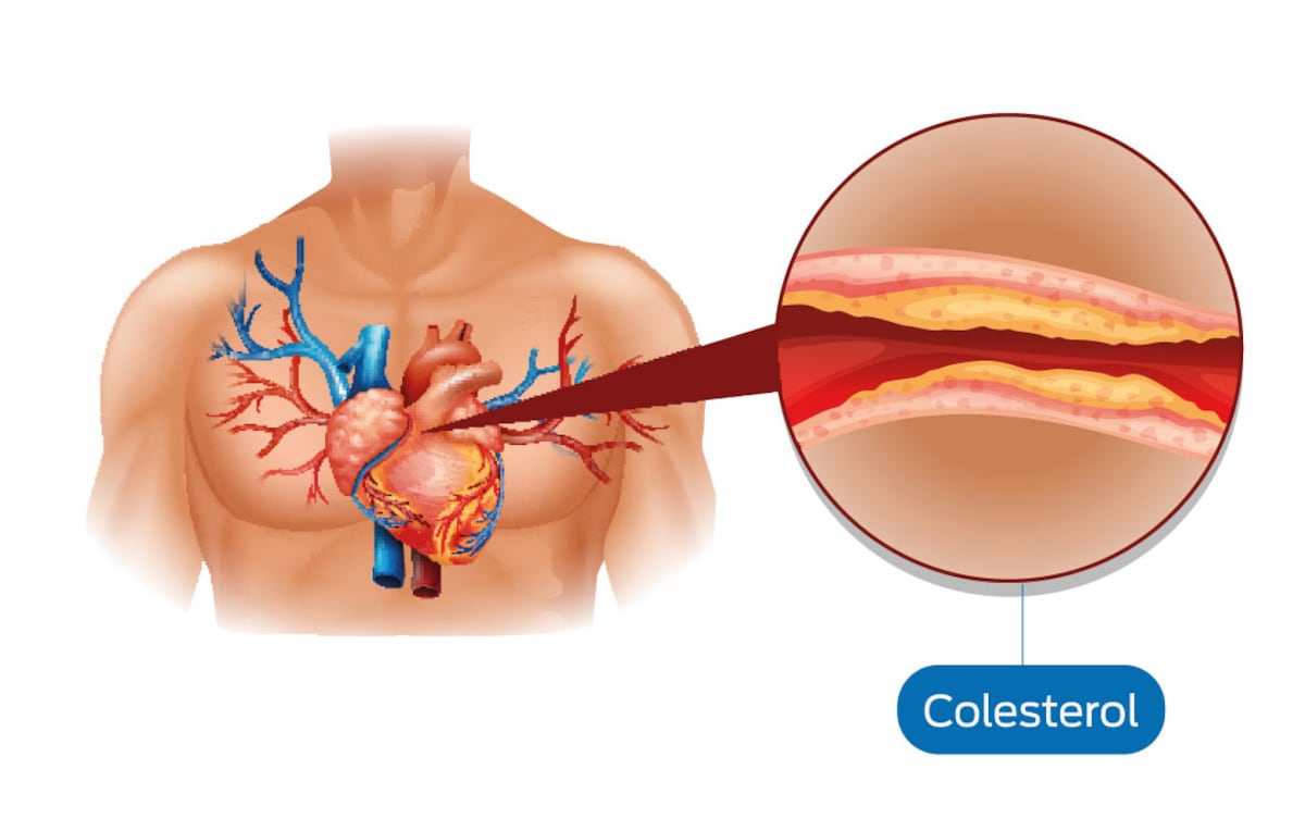 Niveles elevados de triglicéridos contribuyen junto con los de colesterol a la formación de placas en la pared de las arterias (aterosclerosis) / Sanatorio Allende