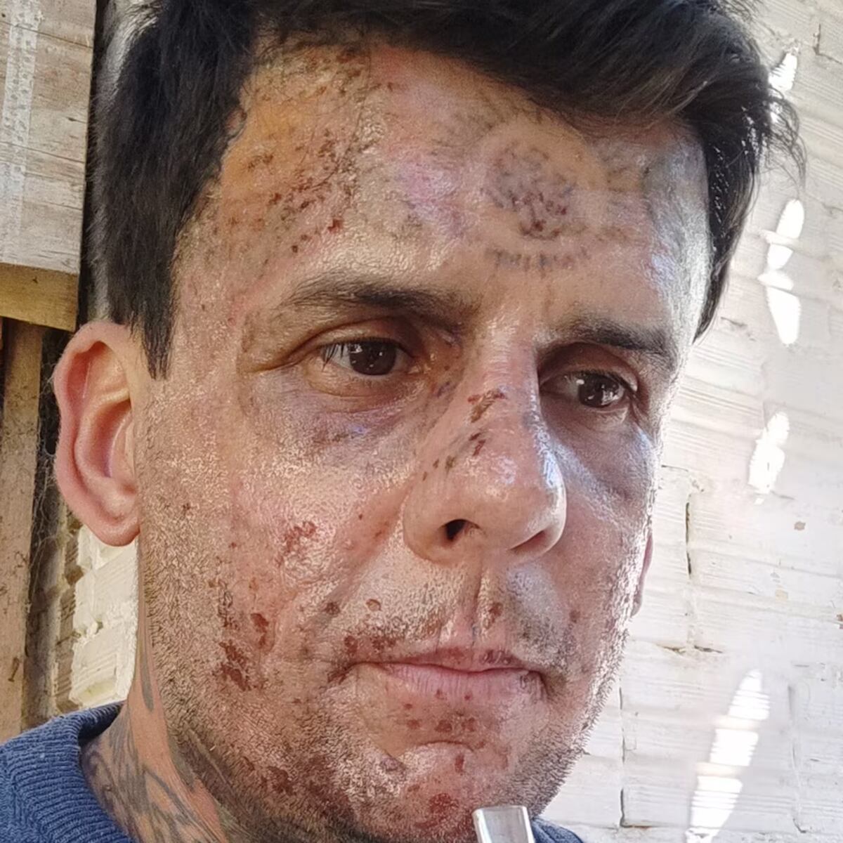 El hombre “más tatuado de Brasil” se empezó a borrar los tatuajes.