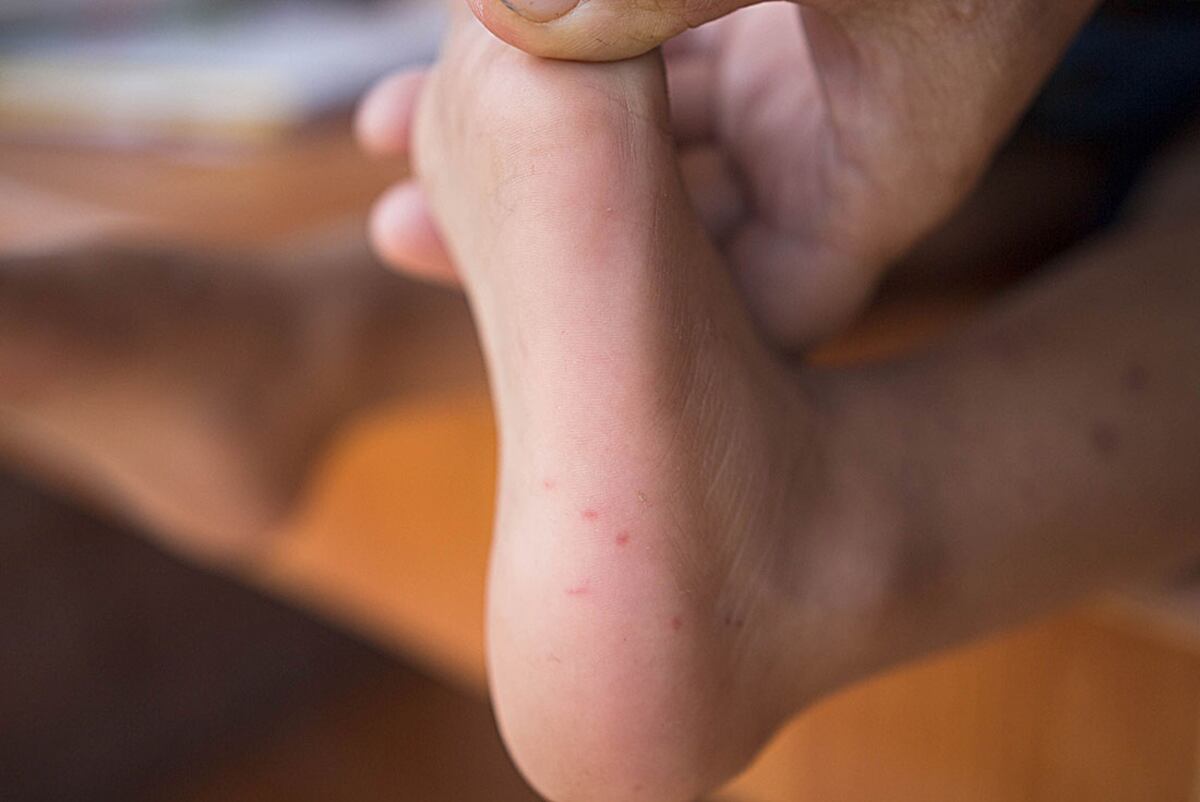 Por lo general, los signos y síntomas desaparecen al cabo de 7 a 10 días de detectada la infección. / Sanatorio Allende