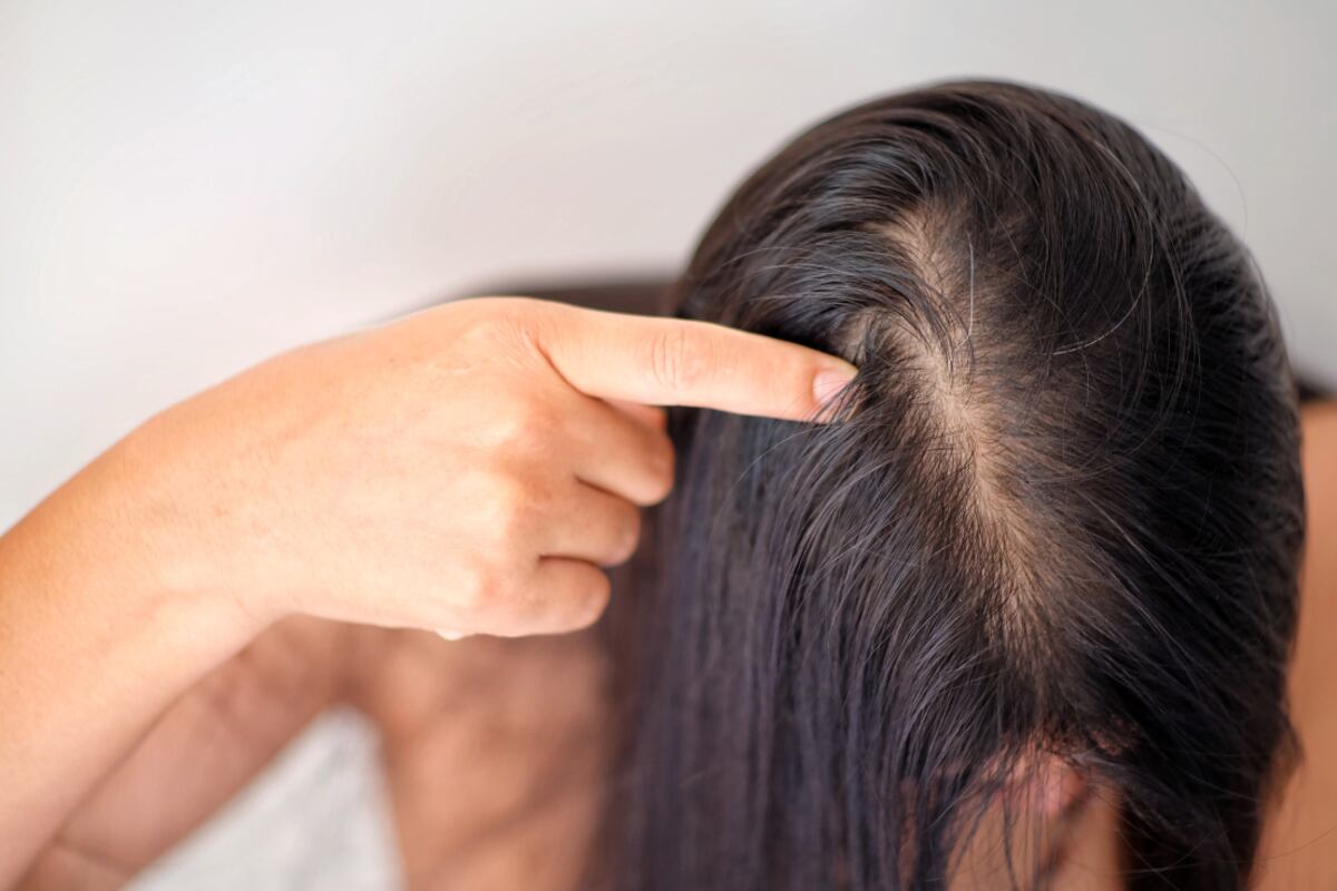 Ante la pérdida capilar, hay que acudir a un especialista en el tema. (Foto: Hair Recovery)