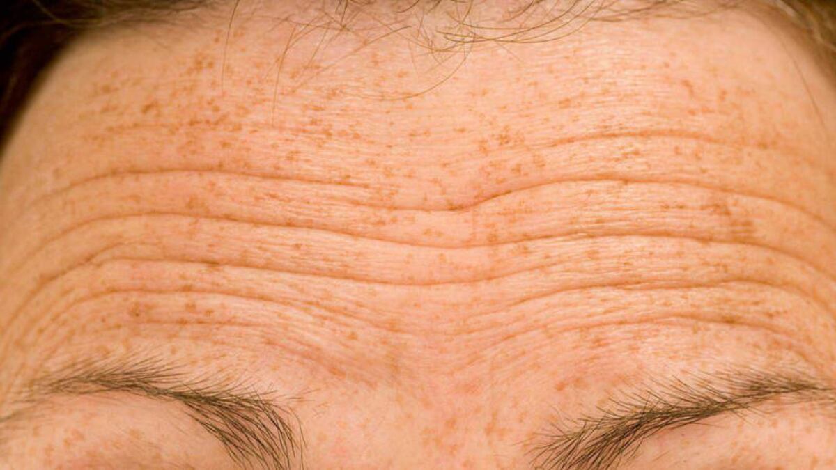 Arrugas producidas mientras dormimos: ¿mito o realidad?