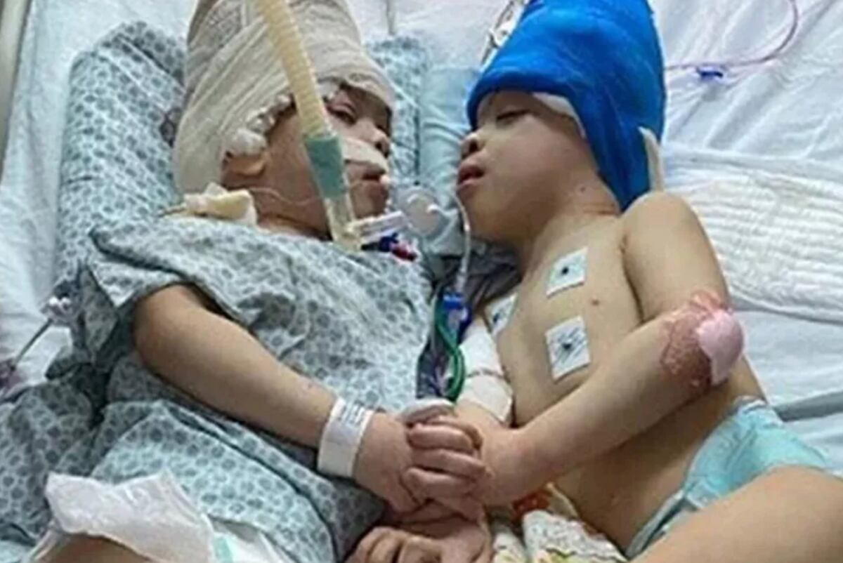 Siameses. Lograron separar a los gemelos Bernardo y Arthur Lima en Brasil. (Foto / PA)