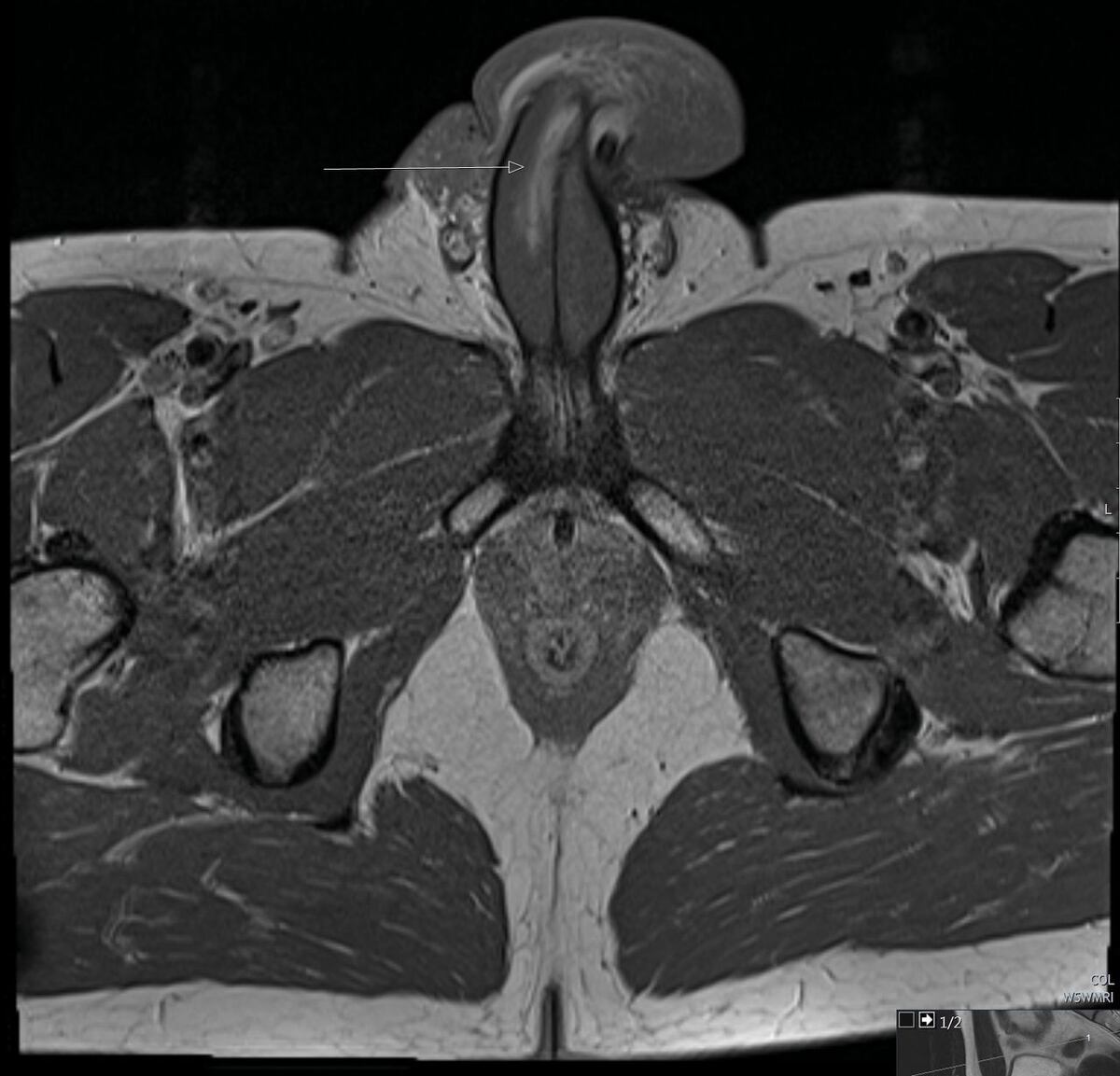 Fractura de pene. (https://casereports.bmj.com/)