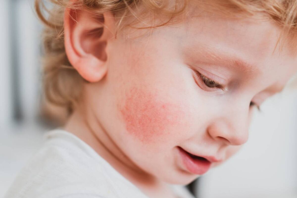 Enrojecimiento, resequedad y picazón son algunas manifestaciones de la dermatitis atópica. (Freepik)