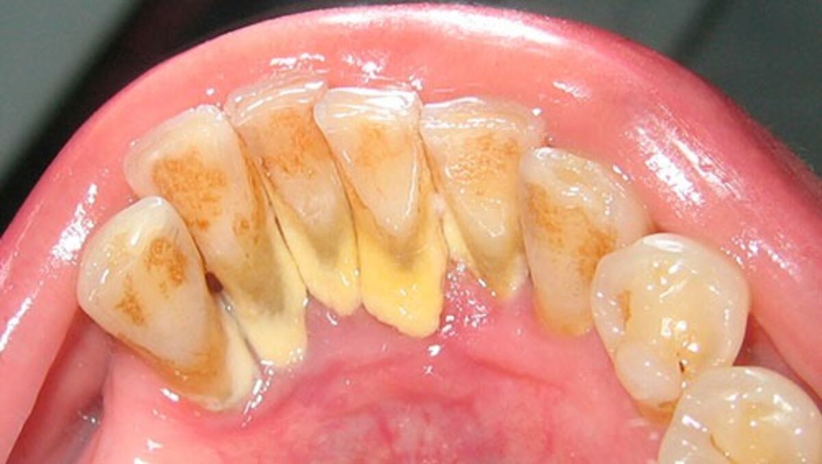 El verdadero “truco” para eliminar el sarro y tener dientes blancos: lo que recomienda el odontólogo