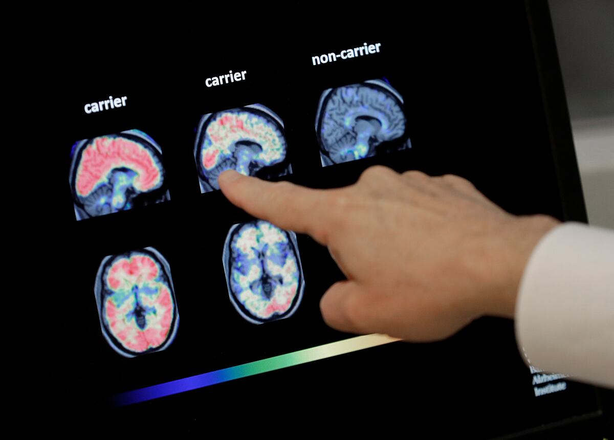 Nueva prueba detecta el Alzheimer 10 años antes de los síntomas