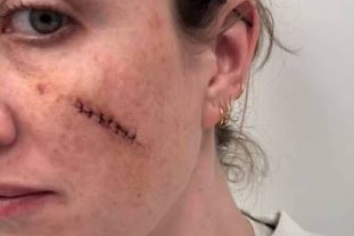 Se apretó lo que creía que era un grano en la cara y acabó con una infección grave: el consejo viral de una joven para que no te pase lo mismo. (Captura de imagen)