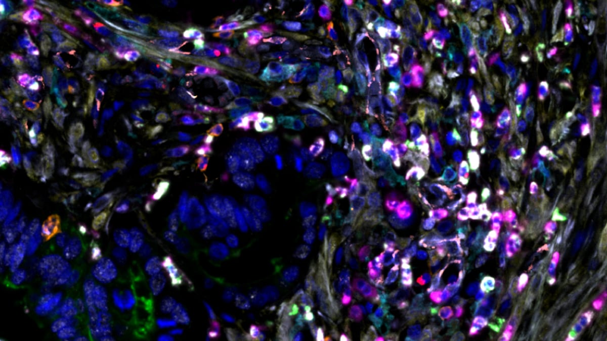Tejido tumoral de cáncer de colon. Se puede observar una expresión elevada de Gal-1, acompañada de una acumulación de Mdscs y baja presencia de linfocitos.