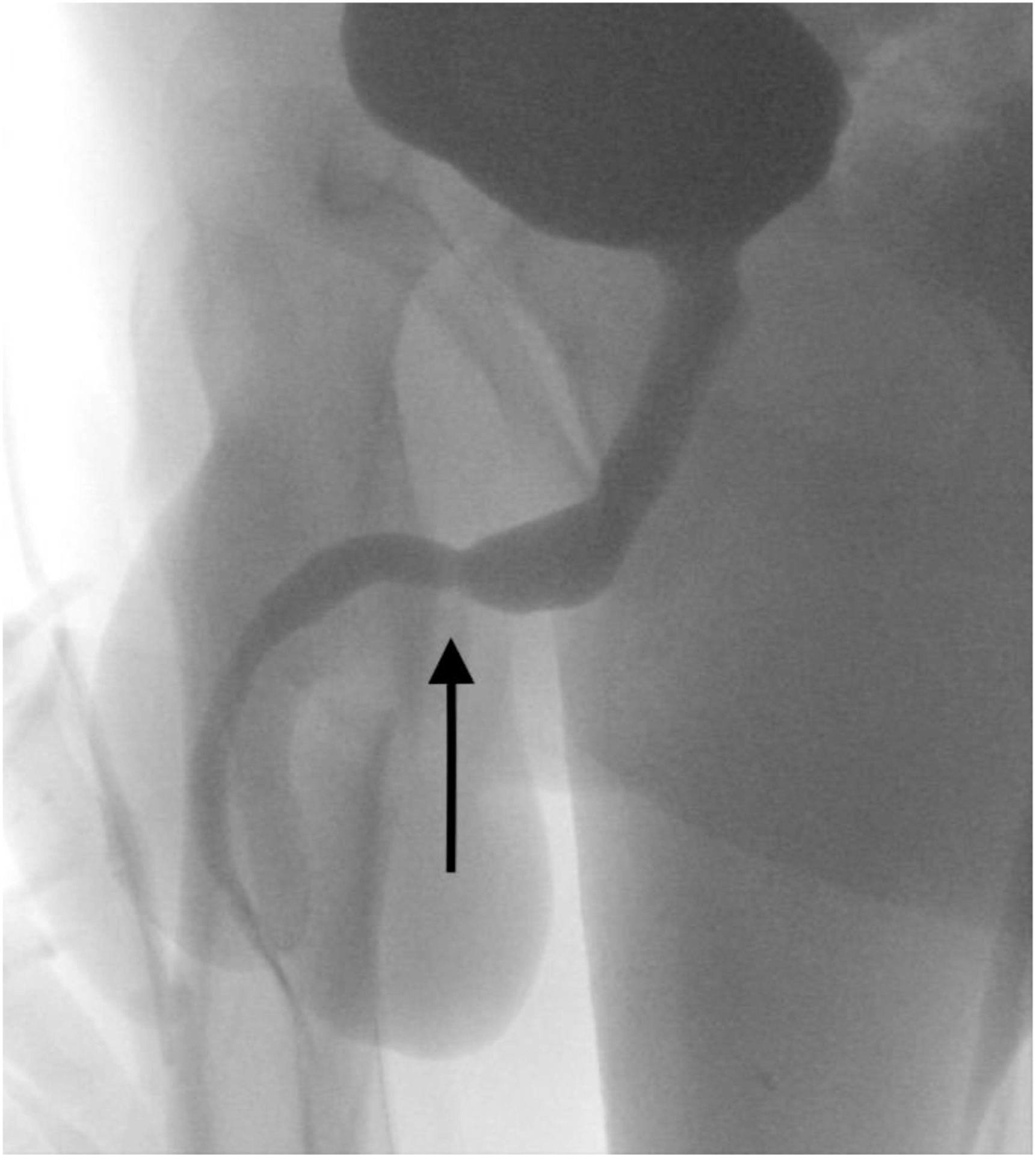 Se encontró encontró una cicatriz que podría estrechar el conducto que lleva la orina fuera del cuerpo. (Urology Case Reports)