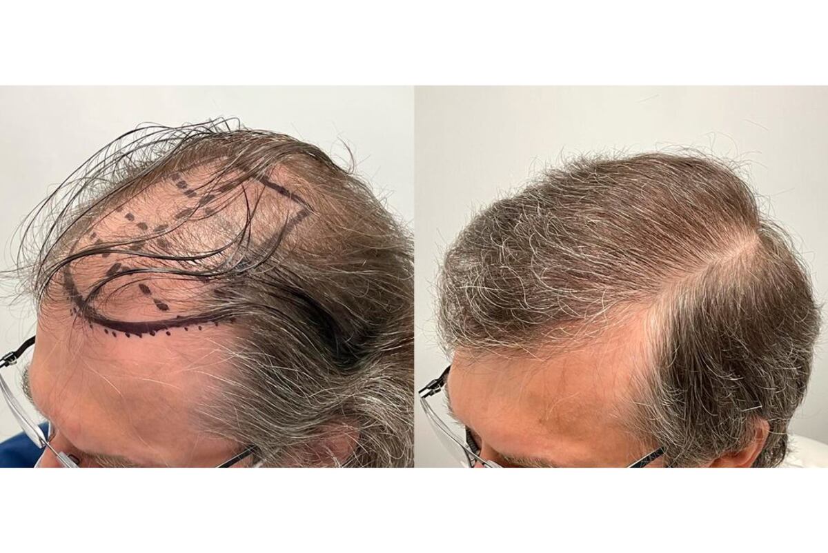 Antes y después de trasplante de 7500 cabellos en una sola sesión.