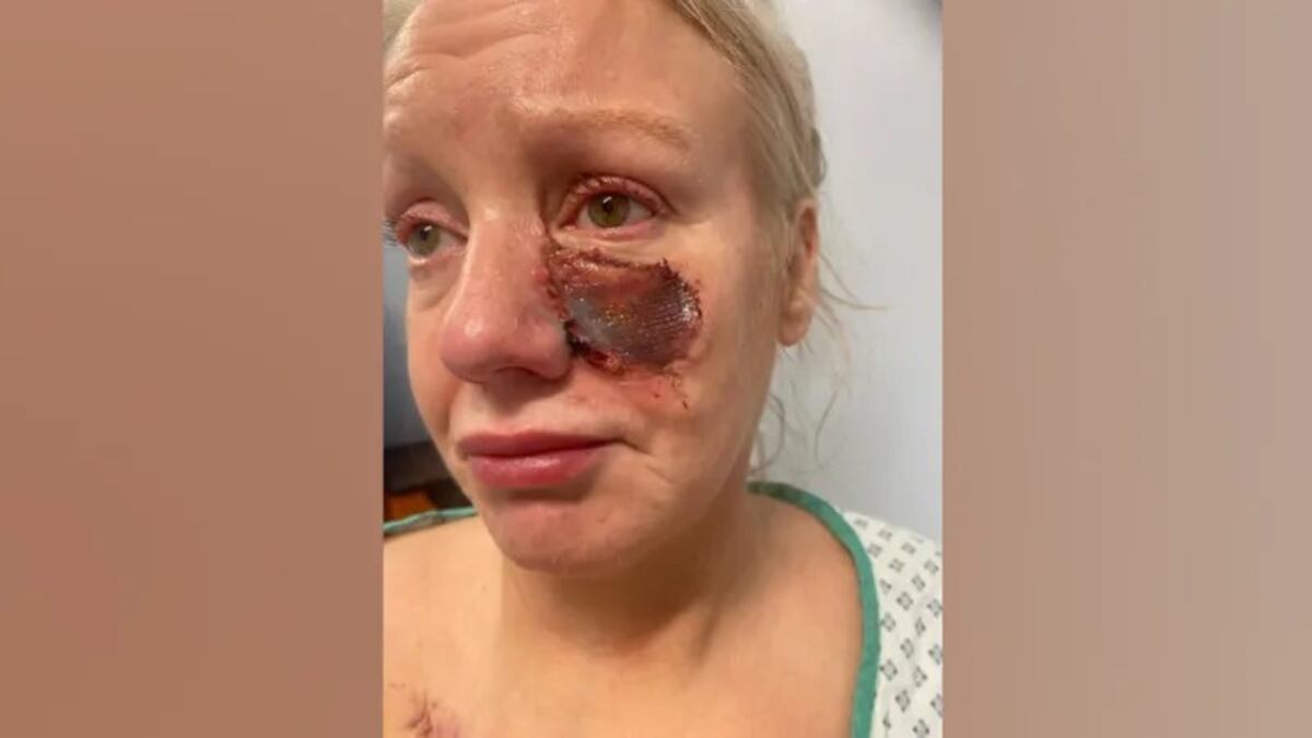 IMÁGENES SENSIBLES. Así quedó el rostro de Kelly Allen. (Gentileza BBC)