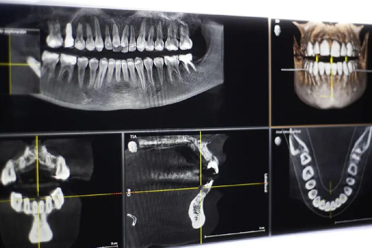 Durante el examen de TC de haz cónico no sentirá ningún tipo de dolor, y podrá volver a sus actividades normales una vez que se haya finalizado el mismo. (Foto: Sanatorio Allende)