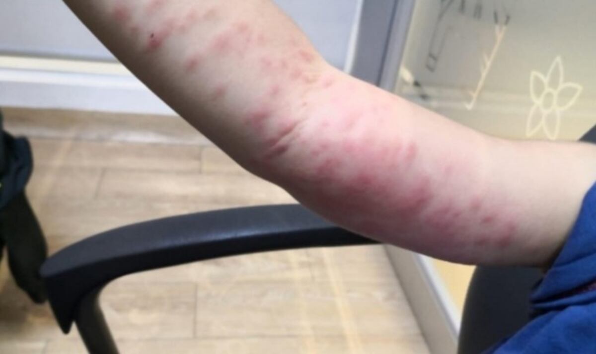 Invasión de polillas negras: por qué no hay que tocarlas y cómo actuar ante una alergia