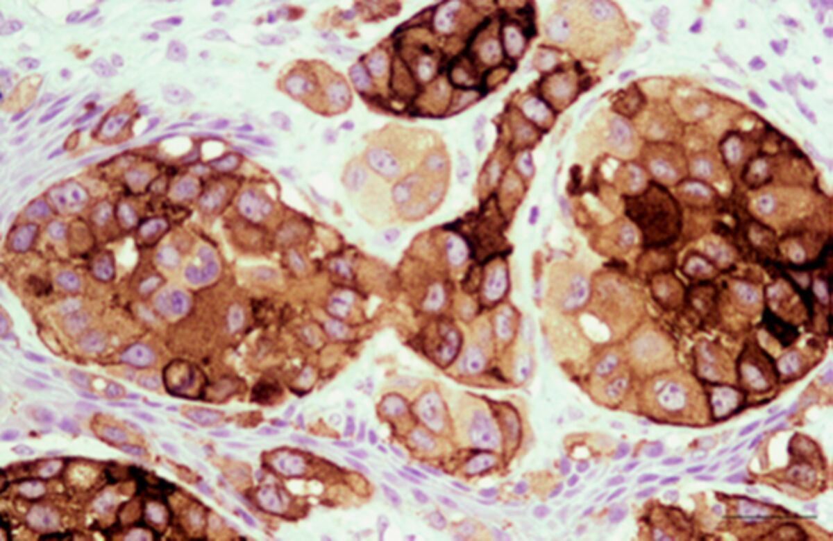 Efecto. La vacuna VACCIMEL activa una fuerte respuesta inmune contra el melanoma. (Agencia Cyta / Fundación Leloir).