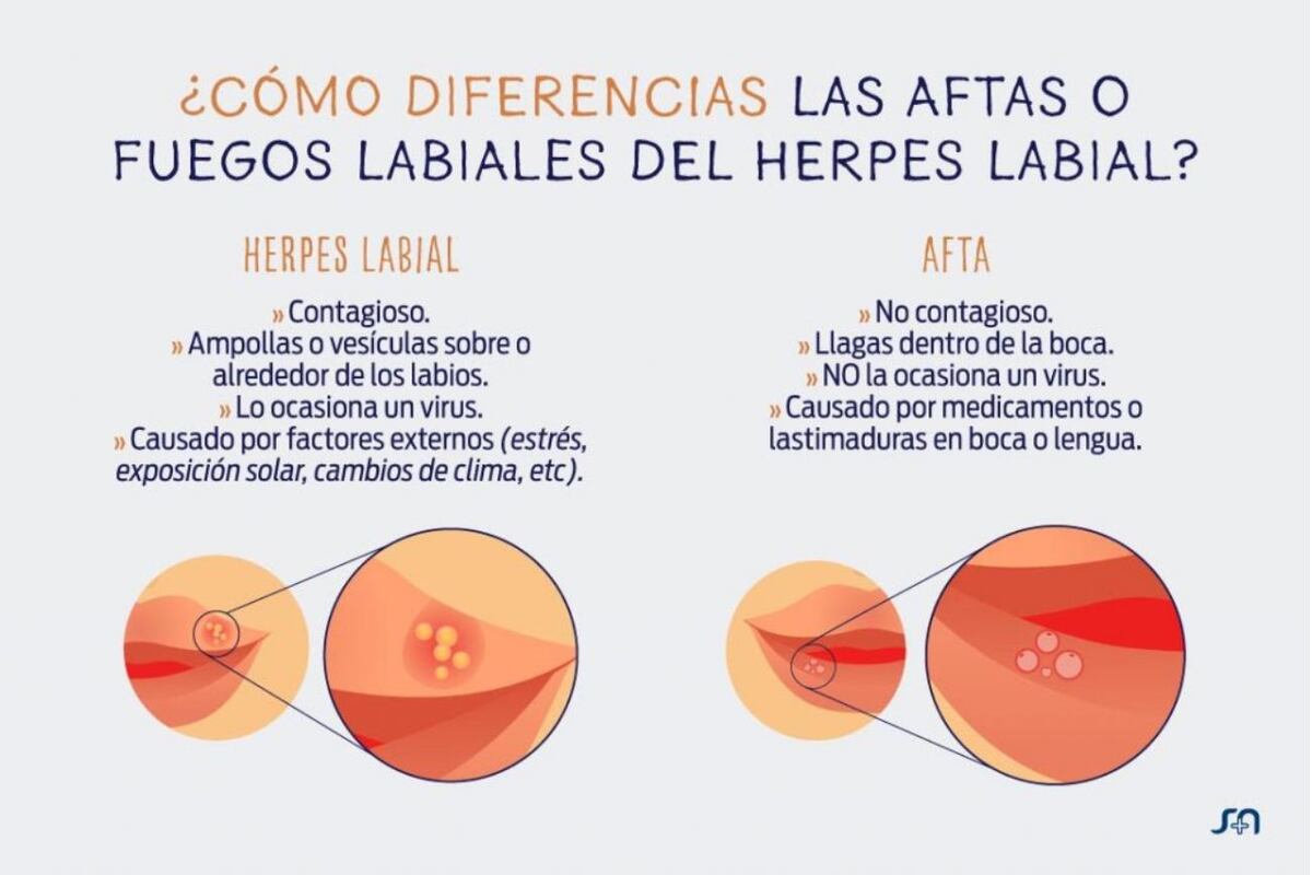 ¿Cómo diferencias las aftas o fuegos labiales del herpes labial?