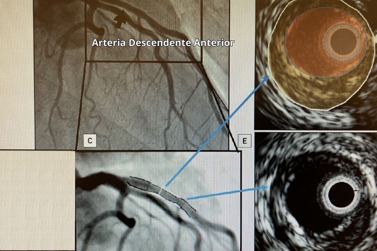 Esta capacidad de IVUS se ha utilizado en estudios clínicos para seguir la progresión/regresión de las placas coronarias.