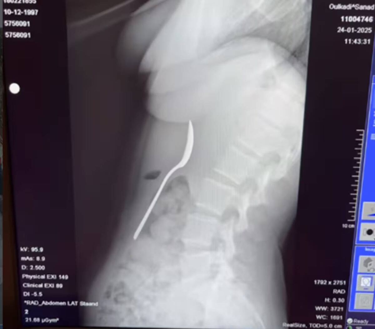 “Era tragar o ahogarme”. Las radiografías mostraron claramente la cuchara de 17 cm en el estómago de la joven. (Fakt)